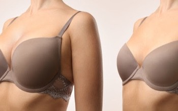 Why is breast reduction gaining popularity by Liposuction?