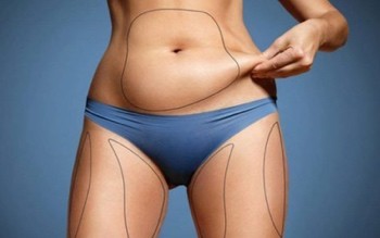 Unterschiede zwischen Liposuktion und Bauchstraffung