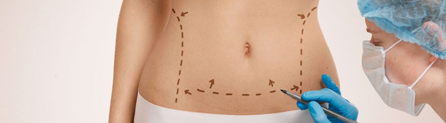 Bauchstraffung (Tummy Tuck)