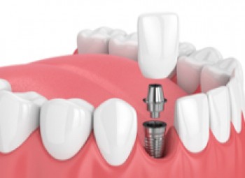 Top questions about dental implant