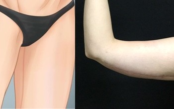 Arm Lift - Thigh Lift: Procedure, Risks, and Results