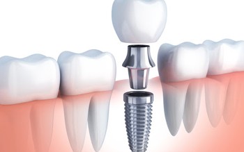 What is dental implant that we have always heard on websites, ads etc.?