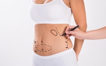 History of Liposuction