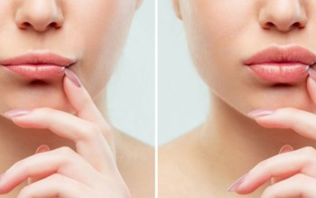 ARE LIP FILLERS SAFE? SHOULD I HAVE LIP FILLERS?