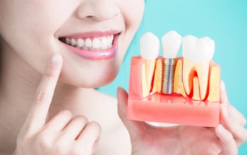 Dental Implants in Turkey or Dental Veneers in Turkey